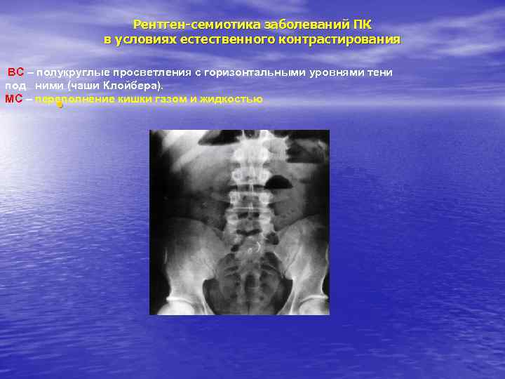 Рентген-семиотика заболеваний ПК в условиях естественного контрастирования ВС – полукруглые просветления с горизонтальными уровнями