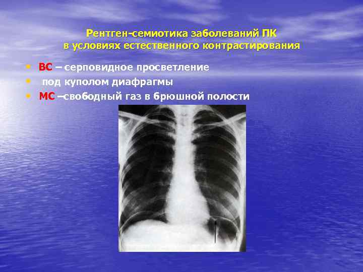 Рентген-семиотика заболеваний ПК в условиях естественного контрастирования • ВС – серповидное просветление • под