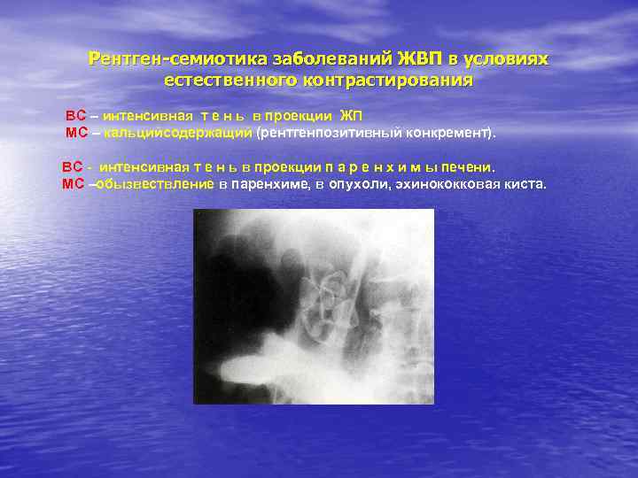 Рентген-семиотика заболеваний ЖВП в условиях естественного контрастирования ВС – интенсивная т е н ь