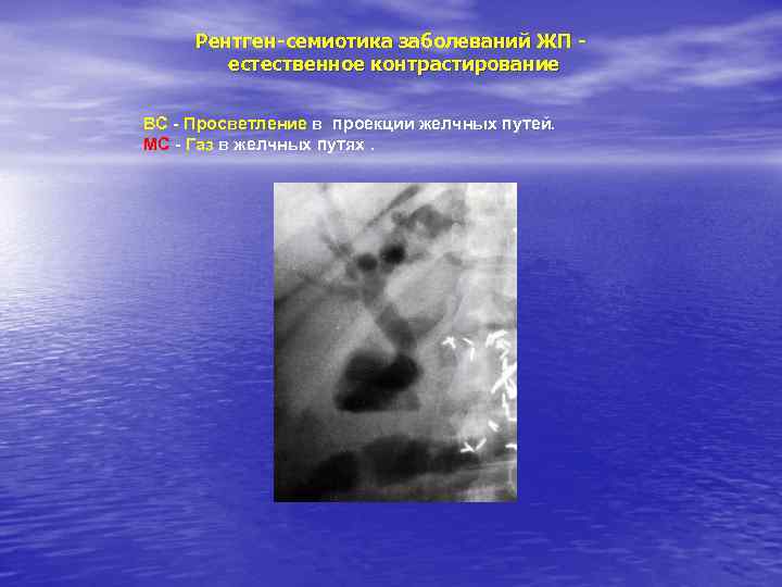 Рентген-семиотика заболеваний ЖП естественное контрастирование ВС - Просветление в проекции желчных путей. МС -