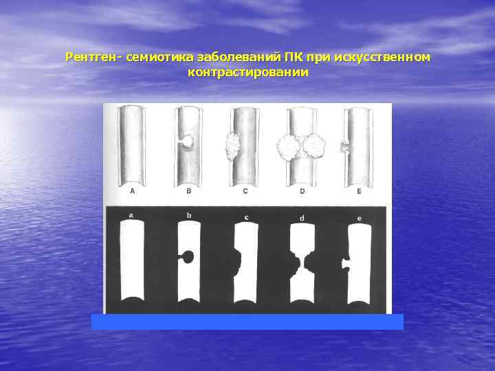 Рентген- семиотика заболеваний ПК при искусственном контрастировании 