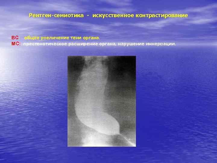 Рентген-семиотика - искусственное контрастирование ВС: общее увеличение тени органа. МС: престенотическое расширение органа, нарушение