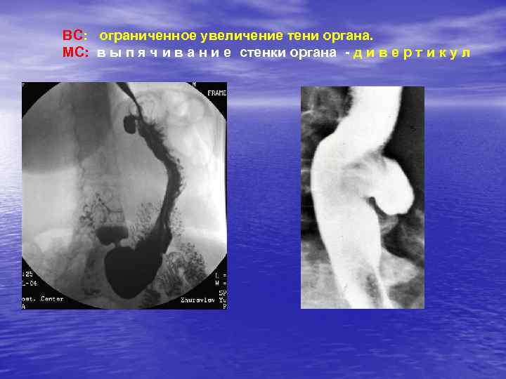 ВС: ограниченное увеличение тени органа. МС: в ы п я ч и в а