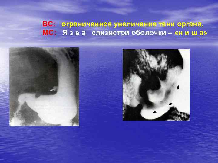 ВС: ограниченное увеличение тени органа. МС: Я з в а слизистой оболочки – «н