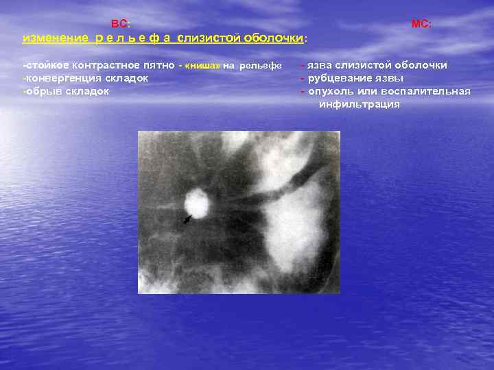 ВС: МС: изменение р е л ь е ф а слизистой оболочки: -стойкое контрастное