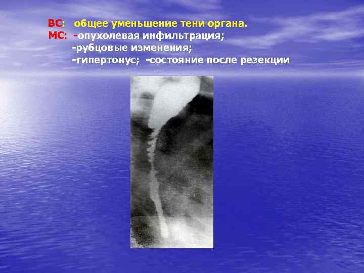 ВС: общее уменьшение тени органа. МС: -опухолевая инфильтрация; -рубцовые изменения; -гипертонус; -состояние после резекции