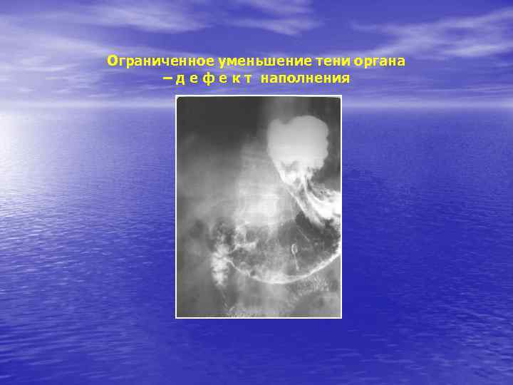Ограниченное уменьшение тени органа – д е ф е к т наполнения 
