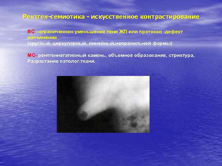 Рентген-семиотика - искусственное контрастирование ВС –ограниченнон уменьшение тени ЖП или протоков -дефект наполнения (круглый,