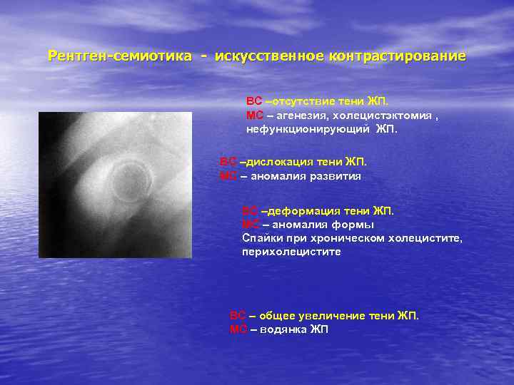 Рентген-семиотика - искусственное контрастирование ВС –отсутствие тени ЖП. МС – агенезия, холецистэктомия , нефункционирующий