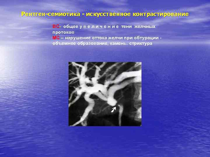 Рентген-семиотика - искусственное контрастирование ВС- общее у в е л и ч е н