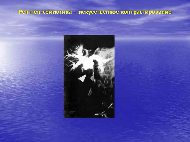 Рентген-семиотика - искусственное контрастирование 