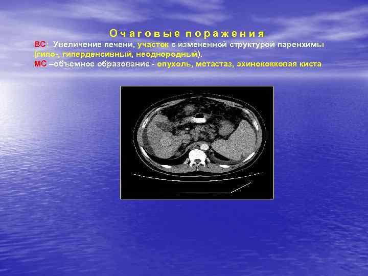 Очаговые поражения ВС: Увеличение печени, участок с измененной структурой паренхимы (гипо-, гиперденсивный, неоднородный). МС