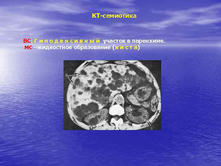 КТ-семиотика ВС: Г и п о д е н с и в н ы
