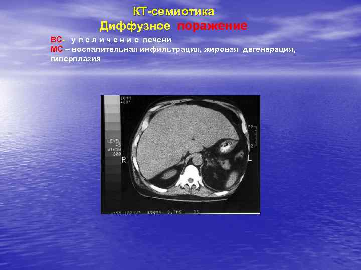 КТ-семиотика Диффузное поражение ВС- у в е л и ч е н и е