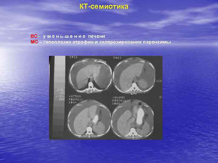КТ-семиотика ВС- у м е н ь ш е н и е печени МС