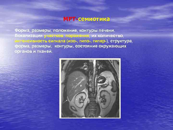 МРТ-семиотика Форма, размеры, положение, контуры печени. Локализация участков поражения, их количество, интенсивность сигнала (изо-,