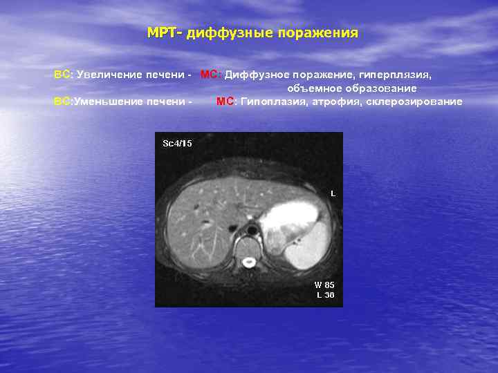 МРТ- диффузные поражения ВС: Увеличение печени - МС: Диффузное поражение, гиперплязия, объемное образование ВС: