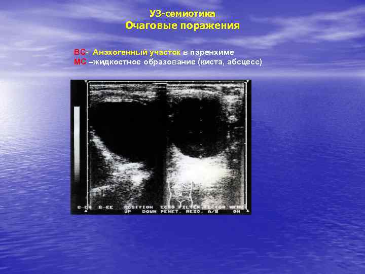 УЗ-семиотика Очаговые поражения ВС- Анэхогенный участок в паренхиме МС –жидкостное образование (киста, абсцесс) 