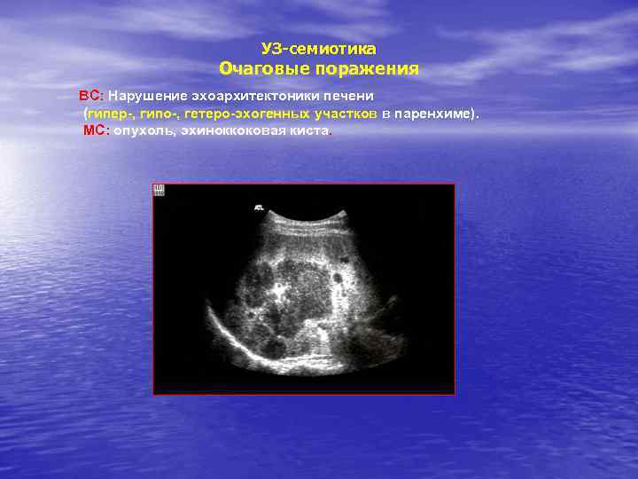 УЗ-семиотика Очаговые поражения ВС: Нарушение эхоархитектоники печени (гипер-, гипо-, гетеро-эхогенных участков в паренхиме). МС: