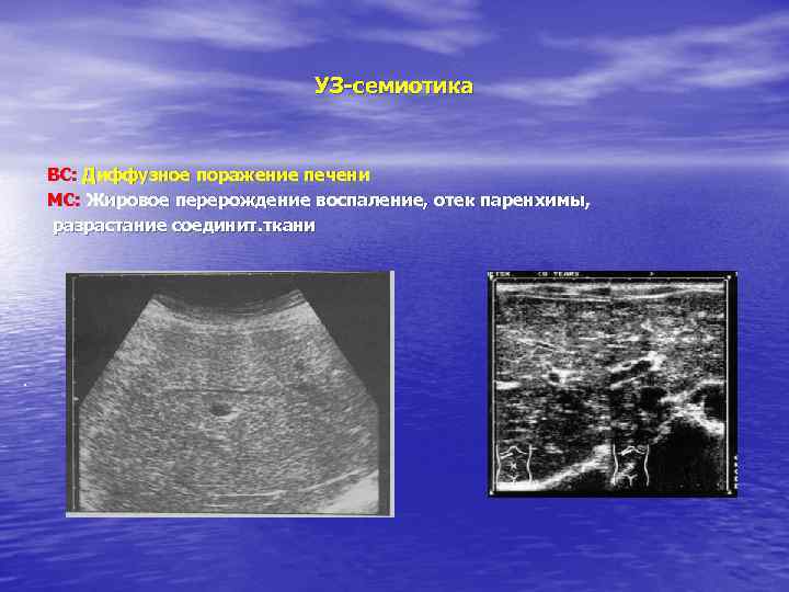 УЗ-семиотика ВС: Диффузное поражение печени МС: Жировое перерождение воспаление, отек паренхимы, разрастание соединит. ткани