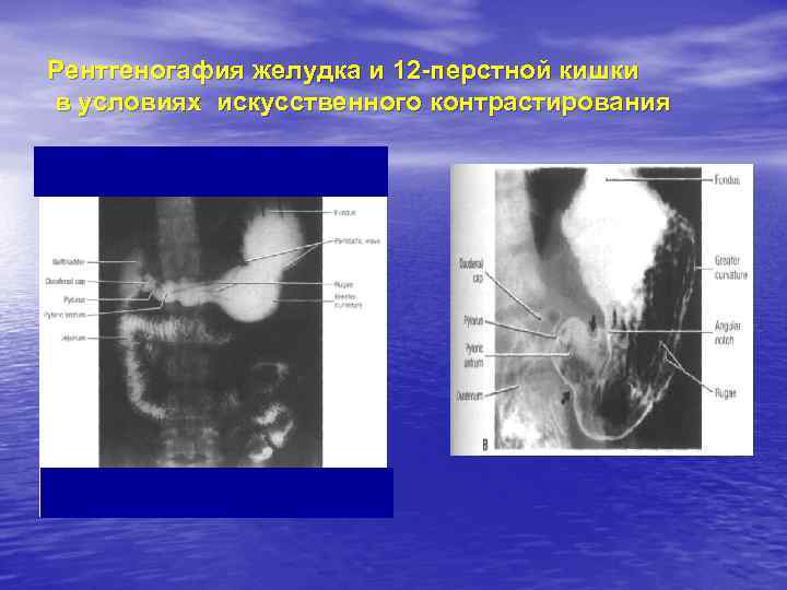 Рентгеногафия желудка и 12 -перстной кишки в условиях искусственного контрастирования 