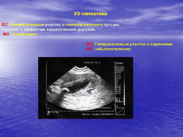 УЗ-семиотика ВС: Гиперэхогенный участок в полости желчного пузыря, потоков с эффектом эхонегативной дорожки. МС