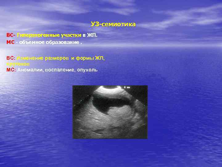 УЗ-семиотика ВС- Гиперэхогенные участки в ЖП. МС - объемное образование. ВС: Изменение размеров и