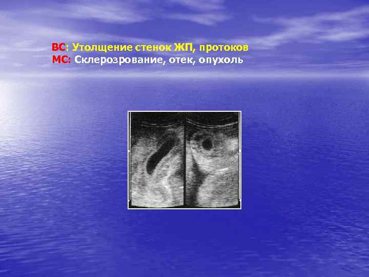 ВС: Утолщение стенок ЖП, протоков МС: Склерозрование, отек, опухоль 