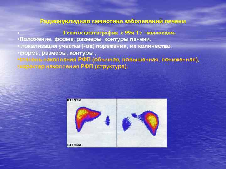 Радионуклидная семиотика заболеваний печени Гепатосцинтиграфия с 99 м Тс –коллоидом. • Положение, форма, размеры,