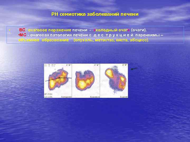 РН семиотика заболеваний печени • ВС: очаговое поражение печени - «холодный очаг» (очаги). •