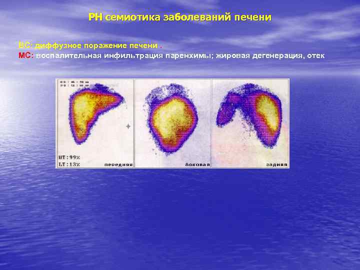 РН семиотика заболеваний печени ВС: диффузное поражение печени. МС: воспалительная инфильтрация паренхимы; жировая дегенерация,