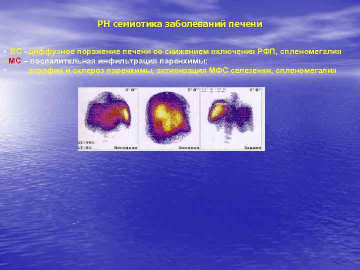 РН семиотика заболеваний печени • ВС –диффузное поражение печени со снижением включения РФП, спленомегалия.