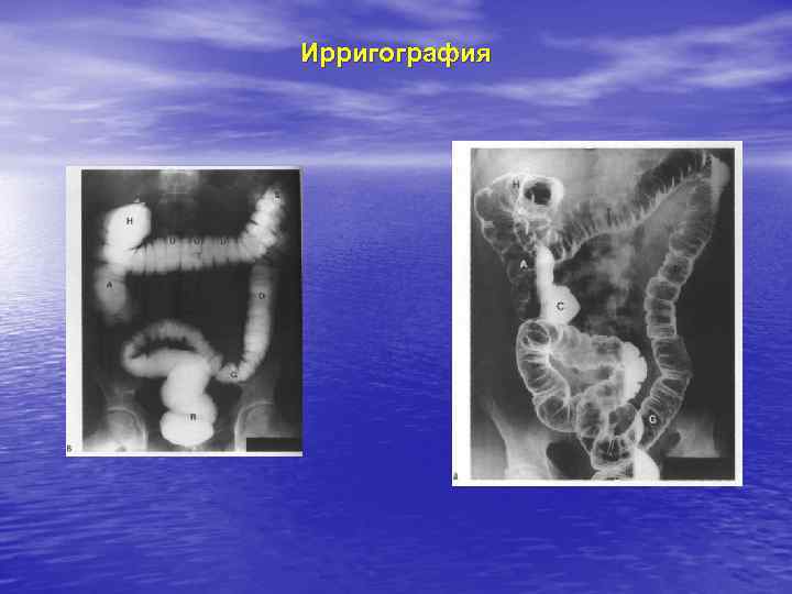 Ирригография 