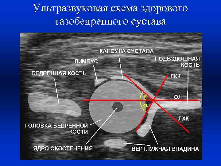 Ультразвуковая схема здорового тазобедренного сустава 