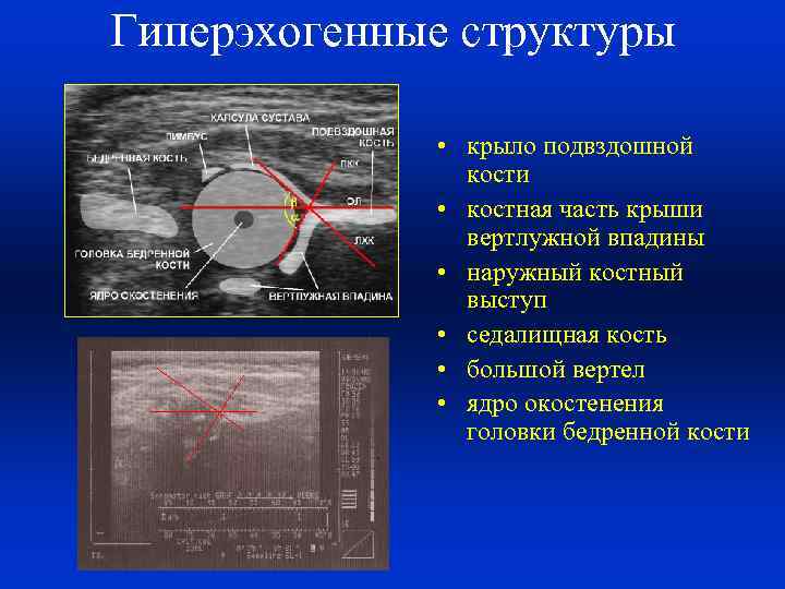 Гиперэхогенные структуры • крыло подвздошной кости • костная часть крыши вертлужной впадины • наружный