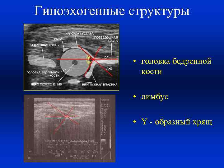 Гипоэхогенные структуры • головка бедренной кости • лимбус • Y - образный хрящ 