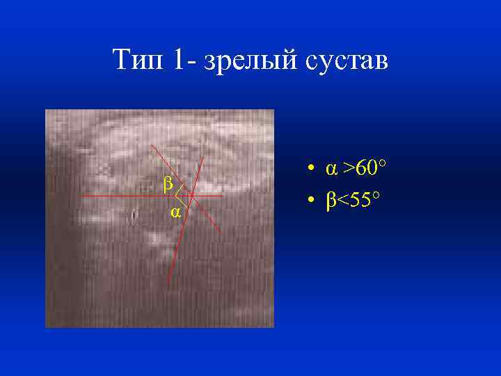 Тип 1 - зрелый сустав β α • α >60° • β<55° 