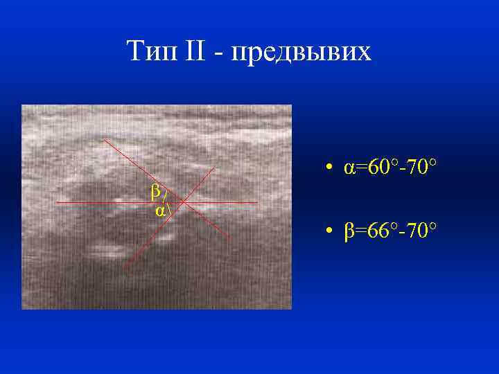 Тип II - предвывих • α=60°-70° β α • β=66°-70° 