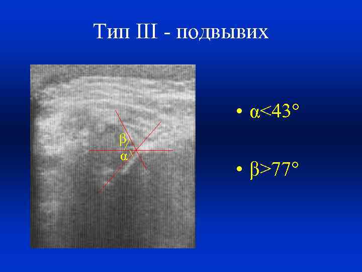 Тип III - подвывих • α<43° β α • β>77° 