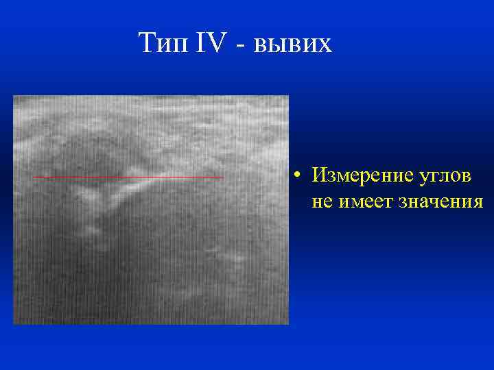 Тип IV - вывих • Измерение углов не имеет значения 