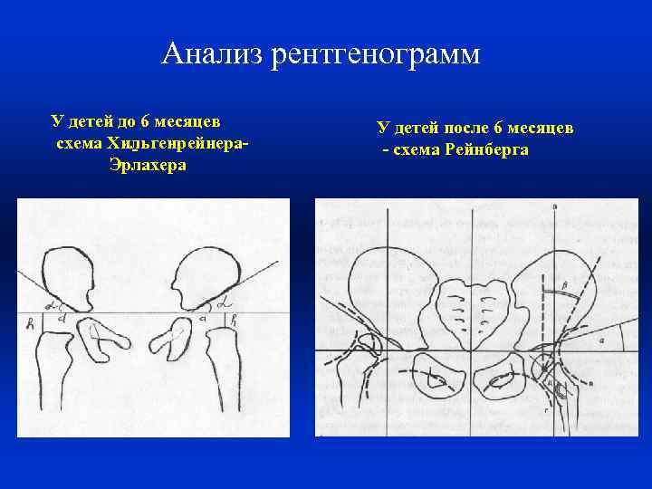 Анализ рентгенограмм У детей до 6 месяцев схема Хильгенрейнера. Эрлахера У детей после 6