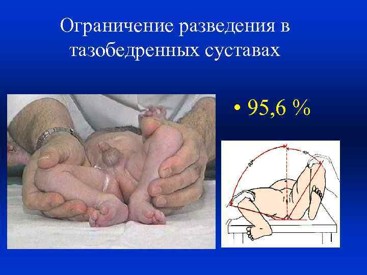 Ограничение разведения в тазобедренных суставах • 95, 6 % 