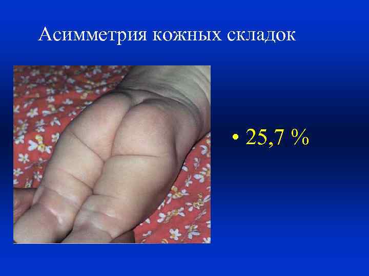 Асимметрия кожных складок • 25, 7 % 