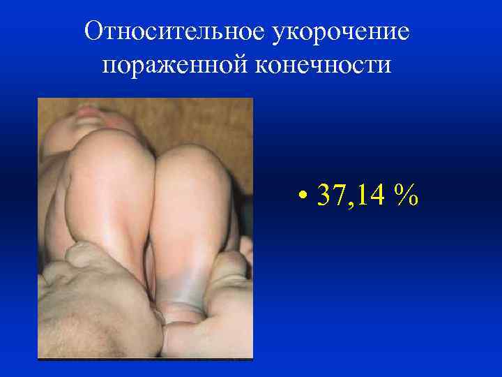 Относительное укорочение пораженной конечности • 37, 14 % 