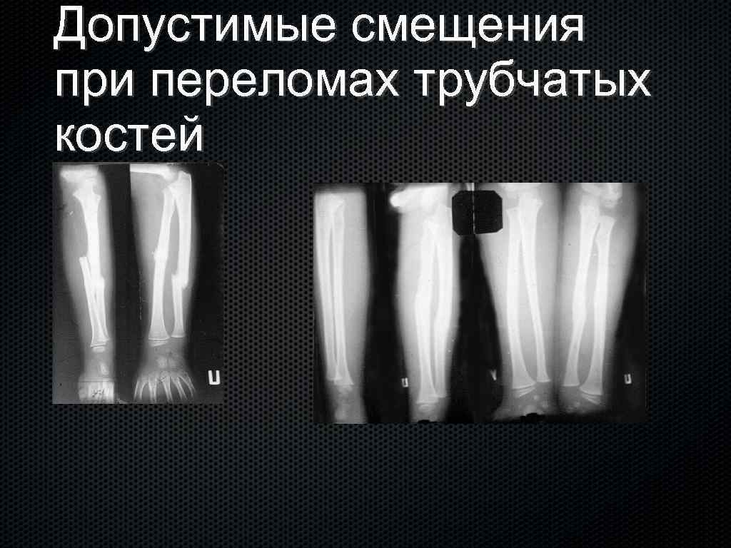 Допустимые смещения при переломах трубчатых костей 