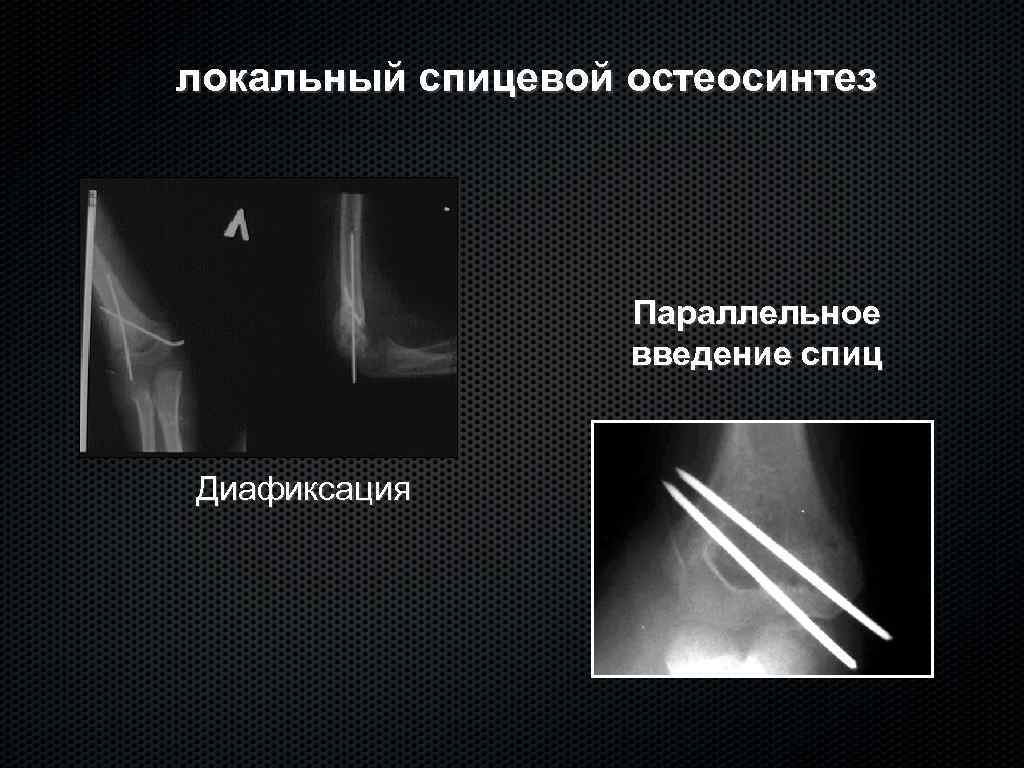 локальный спицевой остеосинтез Параллельное введение спиц Диафиксация 