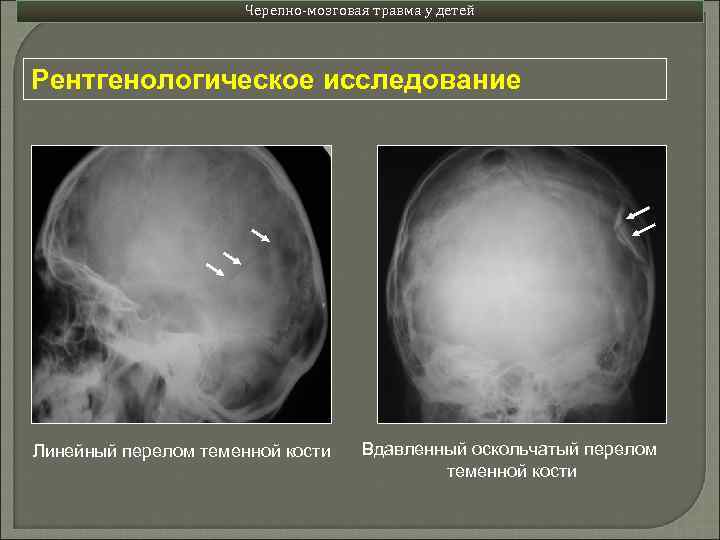 Черепно-мозговая травма у детей Рентгенологическое исследование Линейный перелом теменной кости Вдавленный оскольчатый перелом теменной