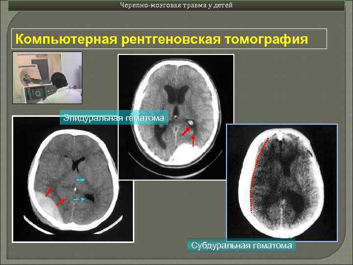 Черепно-мозговая травма у детей Компьютерная рентгеновская томография Эпидуральная гематома Субдуральная гематома 
