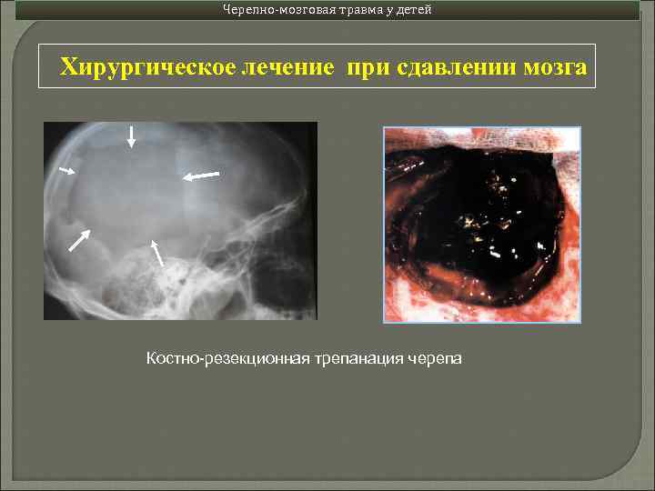 Черепно-мозговая травма у детей Хирургическое лечение при сдавлении мозга Костно-резекционная трепанация черепа 