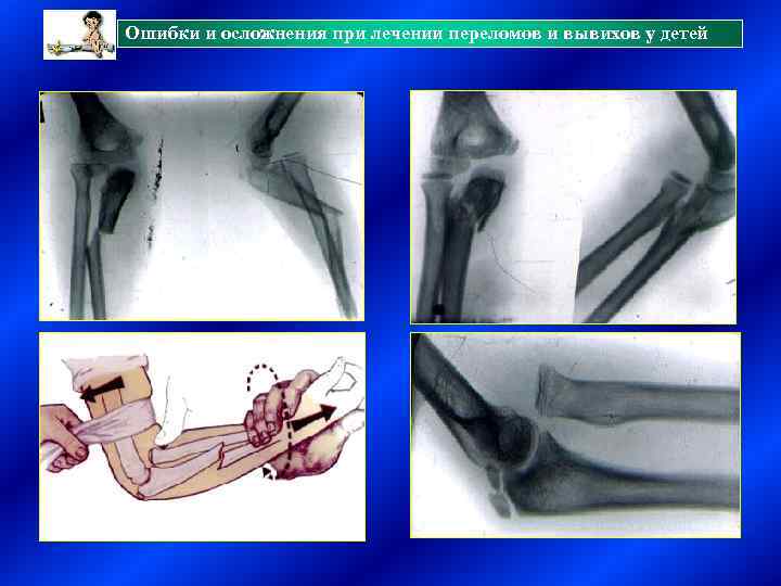 Ошибки и осложнения при лечении переломов и вывихов у детей 